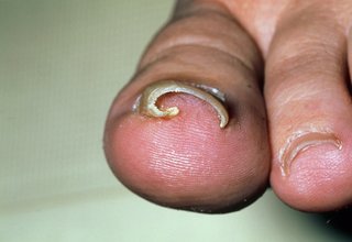 A curved ingrown toenail on big toe, shown on white skin.