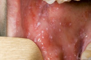 An open mouth with small greyish-white spots on the inside of the cheek