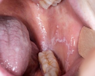 photo of inside a mouth, including some back teeth, inner cheek with white patches and tongue with white patches