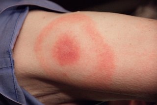 Large red circular rash on an arm, with large red dot in the middle of the circle