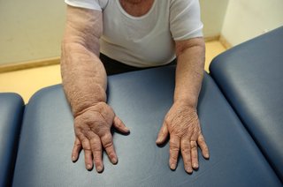A pair of hands and wrists side by side, one is swollen with lymphoedema