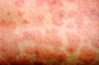 Close-up of skin with a measles rash. The red, raised spots are joined together in blotchy patches. Shown on white skin.