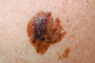 2 images side by side showing brown melanomas on white skin with notched or raggedborder