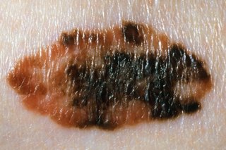 2 images side by side each showing how melanomas have a mix of 2 or more coloirs. One is pink and black, 1 is brown and black.