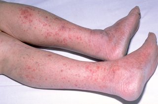 The rash usually starts as small, red pin-pricks. It spreads quickly and turns into red or purple blotches.