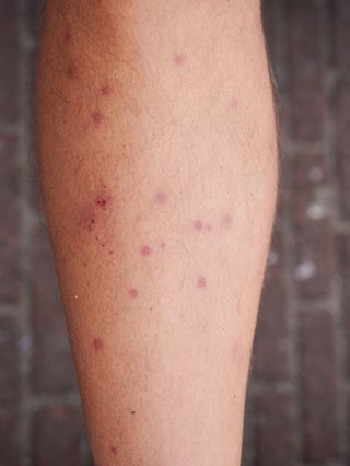 Mite bites shown on white skin. There are small red lumps where the skin was bitten.