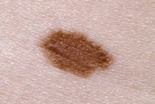 normal light brown mole on white skin