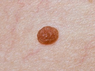 mole on white skin that is round, with even edges and a light brown colour
