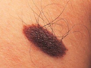 oval mole on white skin with multiple hairs growing from it, and brown in colour