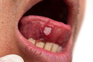 Clear white-coloured mouth ulcer on the tip of the tongue