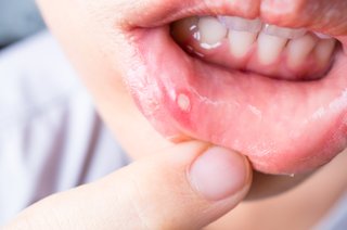Single mouth ulcer on the inside of the bottom lip
