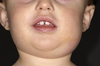 A child with a swollen face caused by mumps