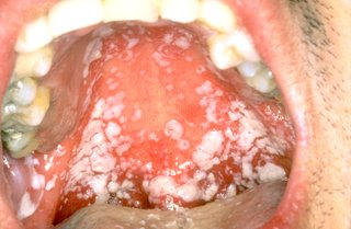 Close up of the inside of a mouth. There are white spots at the back and sides of the mouth.