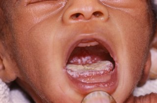 Close up of a baby's open mouth. A white coating covers the tongue. There are white spots at the back of the mouth.