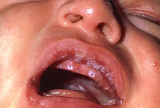 Close up of a baby's open mouth. There are white spots inside the lips and mouth.