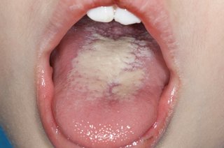 photo of a child's tongue with a large white patch on it.