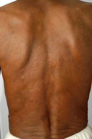 Raised, scaly patches that are hard to see, shown on black skin