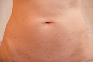Small, raised, scaly patches that are pink on the lower tummy, shown on white skin