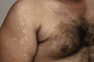 Large patch of skin on the chest and upper arm that is paler than the surrounding skin, shown on brown skin