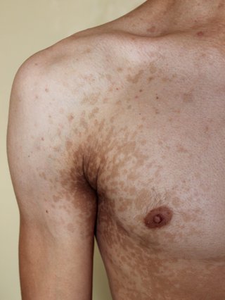 Patches of pale brown skin on the chest, shown on white skin.