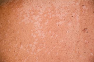 Small patches of skin that is paler than the surrounding skin and joining together to form a large patch