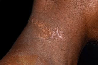 Patch of scaly skin that is paler than the surrounding skin on the neck, shown on black skin.