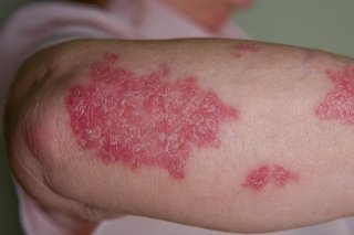 arm below the elbow with red, scaly patches on white skin