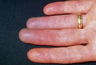 hands with red fingers