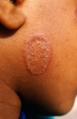 ringworm spreading on brown skin