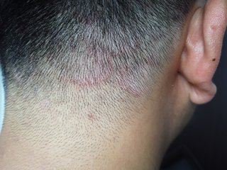 ringworm on the scalp