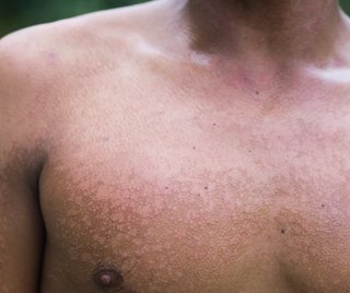 ringworm spreading on the back