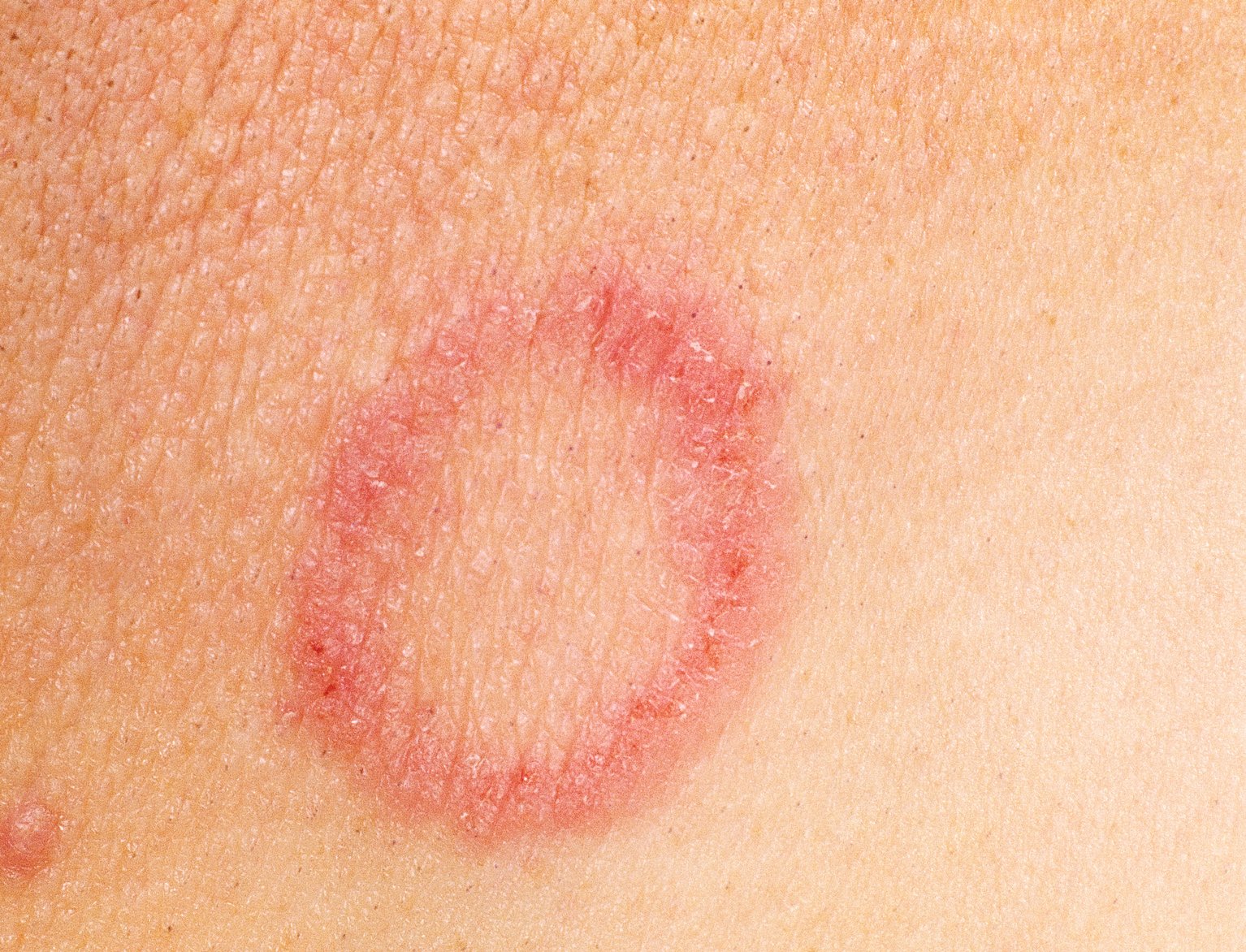 Skin redness and irritation