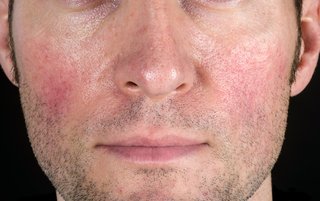 Close up of red patches caused by rosacea on the cheeks of a man with white skin.