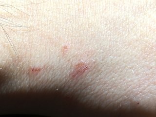 Tiny bumps in a line with a dot at one end, shown on white skin.