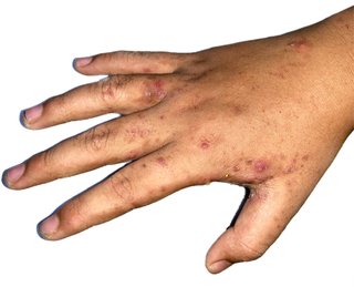 Dark spots caused by scabies on a hand with brown skin.