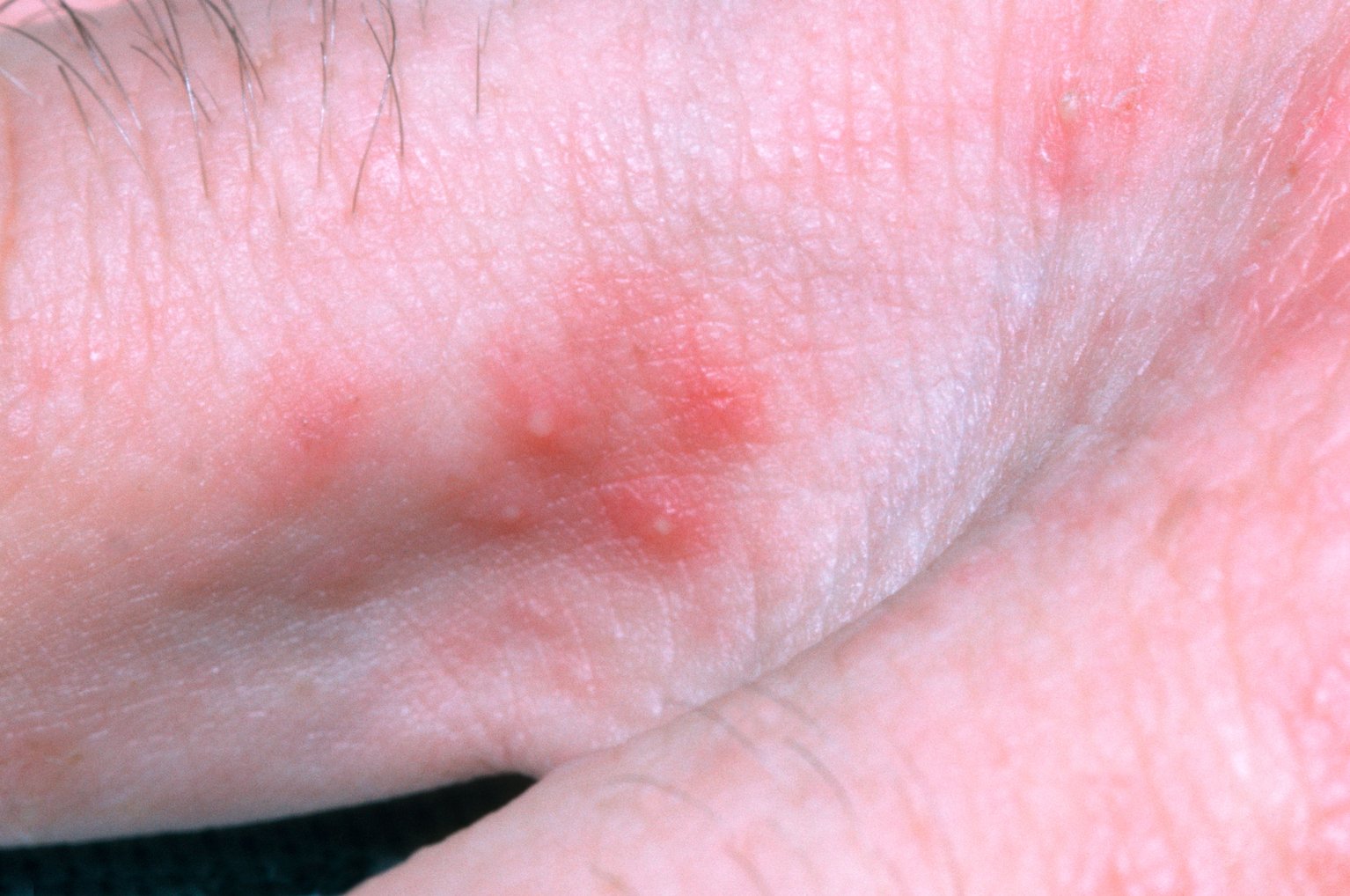 Scabies: symptoms, causes, diagnosis and treatments
