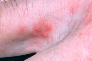 A hand with white skin shows a red rash in between the fingers, across the knuckles and the back of the hand