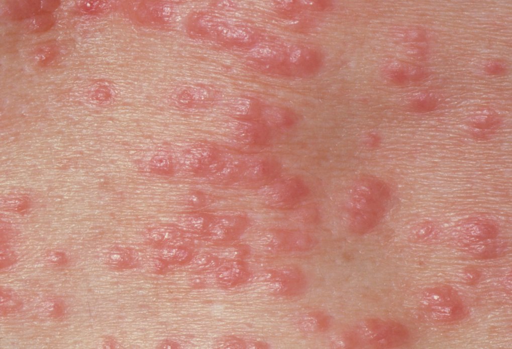 Skin Rash Scabies Scabies: symptoms, causes, diagnosis and treatments