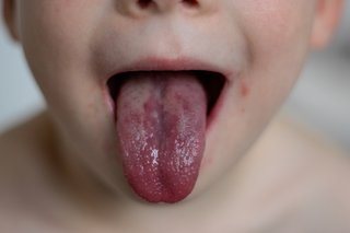 A swollen red tongue.