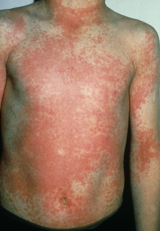 A child with a spotty red rash on their chest
