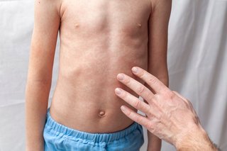 An adult hand checking the skin on a child's tummy.