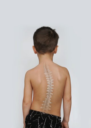 An image of the back of the body of a white child affected by scoliosis, showing a noticeable curve of the spine which is illustrated by a superimposed spine