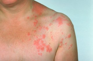 chest and shoulder of person with red blotches on white skin, on one side of their body only
