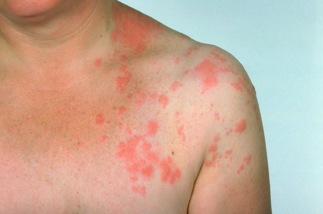 Stringer Rash Rash: types, causes, diagnosis and treatments