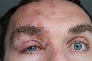 A red rash around someone's almost closed eye, shown on white skin.