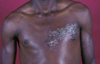 A large scabbed area on one side of someone's chest. Shown on black skin.