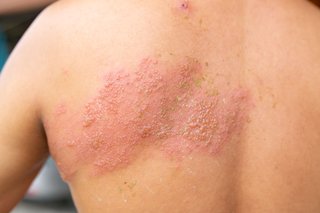 A large area of blisters on someone's back. Shown on brown skin.