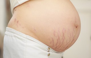 stretch marks on pregnant tummy