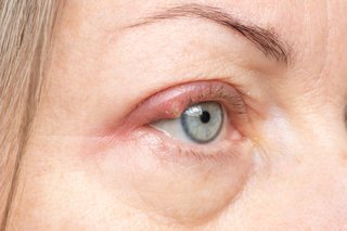 A stye on an eyelid
