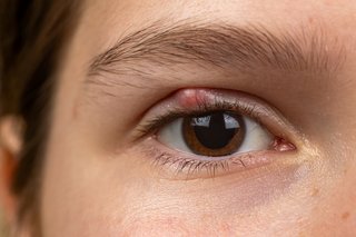 a stye on the upper eyelid